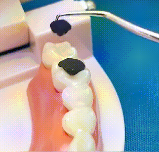 【🔥Купете 1 и получете 1 безплатно🔥】🦷Комплект клечки за зъби от неръждаема стомана